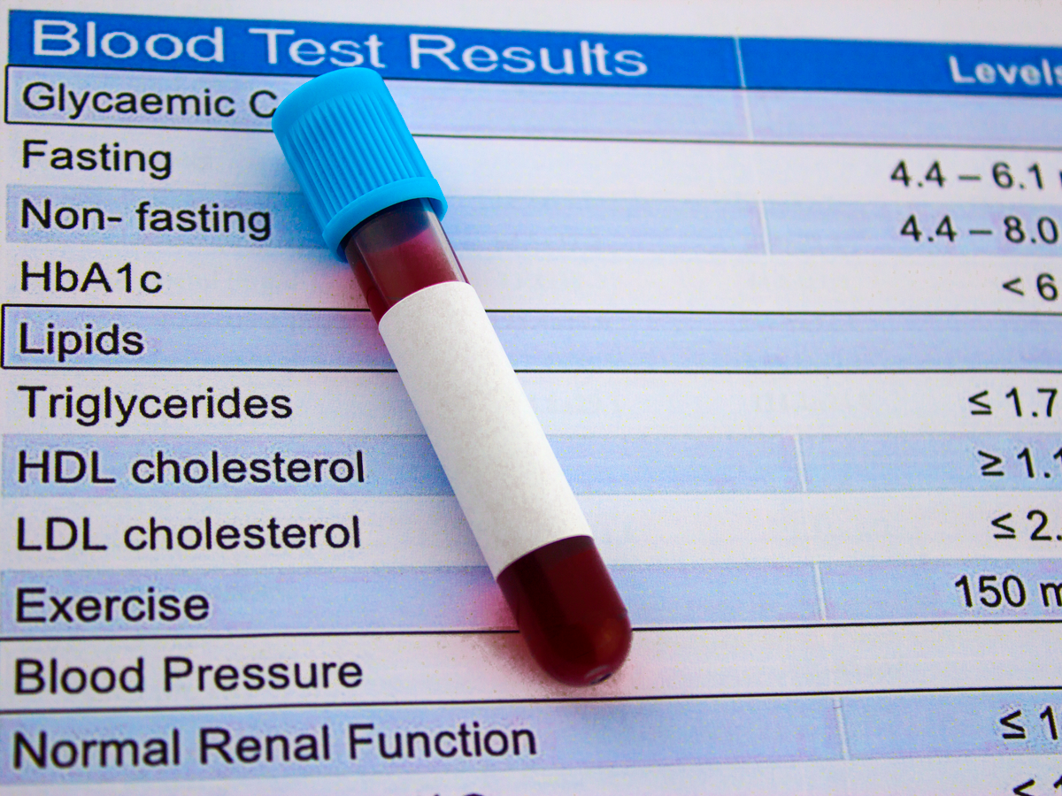 A vial of blood in a test tube with a blank white label lays ontop of a spreadsheet with blue and white rows with various test result listings. (Stock image)