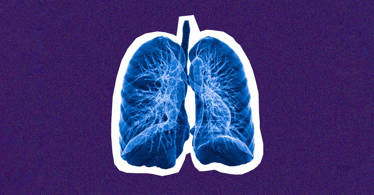 Lung cancer is the leading cancer killer. Why is screening so rare?