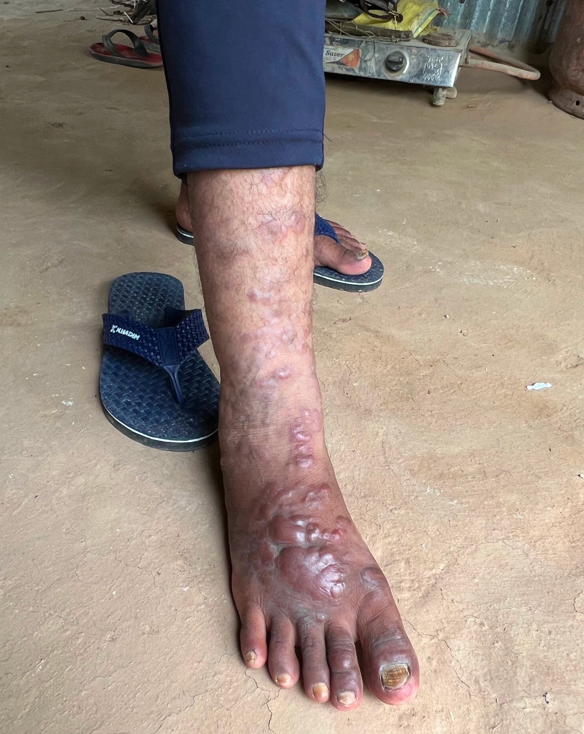 A male Indian foot and ankle with puffy pink lesions caused by post-kala-azar dermal leishmaniasis, or PKDL